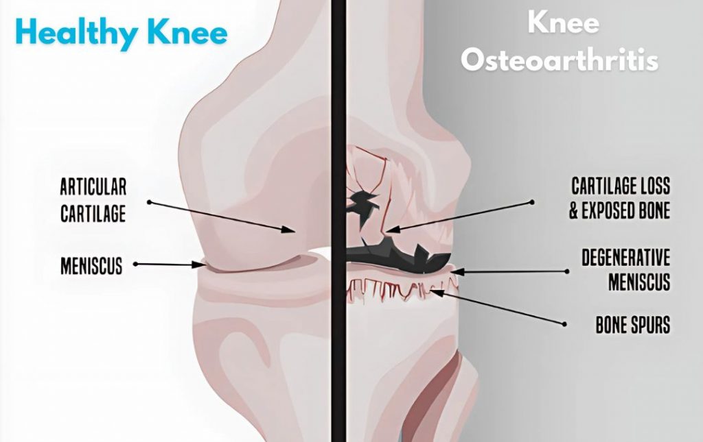 Osteoarthritis of the knee treatment comparison infographic.