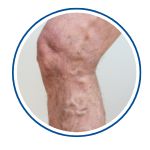 Vein Treatment