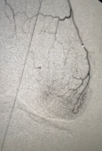 Image of Genicular Artery Embolization (GAE) at USA Pain Center