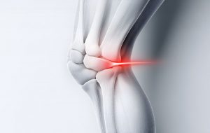 Living with bone-on-bone knee arthritis