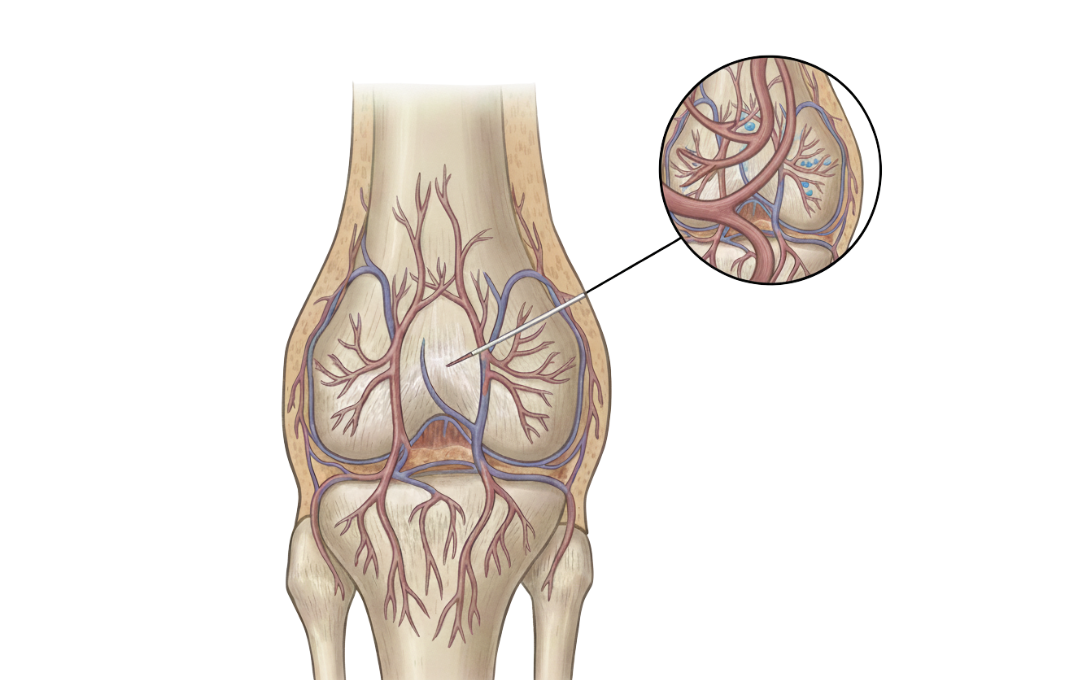 Illustration on how genicular artery embolization works on knee pain