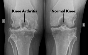 X-ray of a patient with knee arthritis. The narrowing of the space between the bones can indicate loss of cartilage.