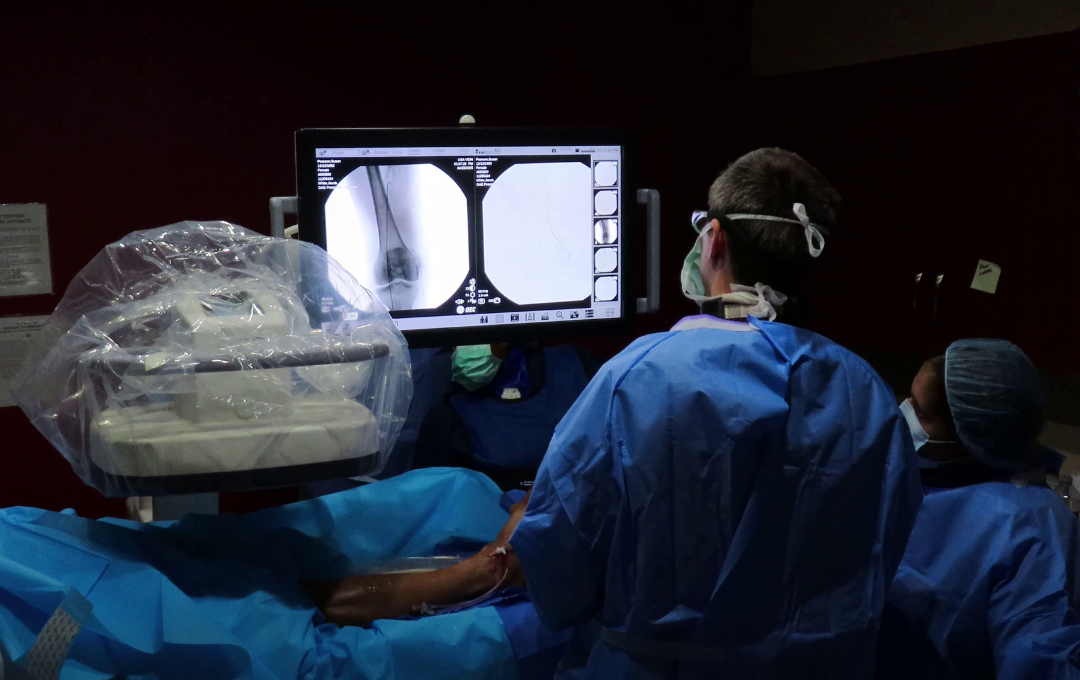 genicular artery embolization at work