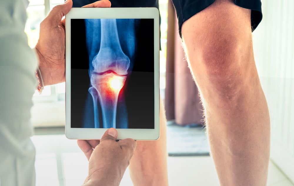 Doctor showing What Does Knee Arthritis Pain Feel Like in the Knee