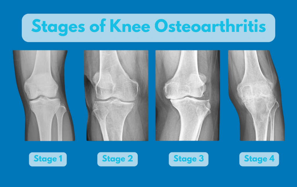 The Four Stages Of Knee Osteoarthritis | USA Pain Center