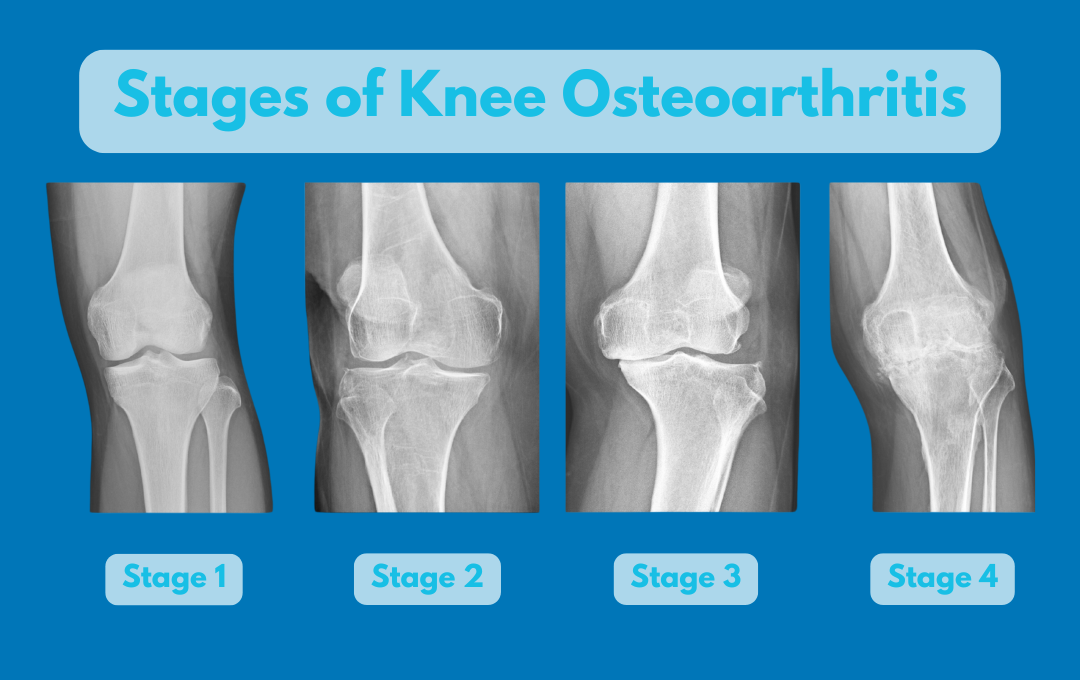 The stages of knee osteoarthritis.