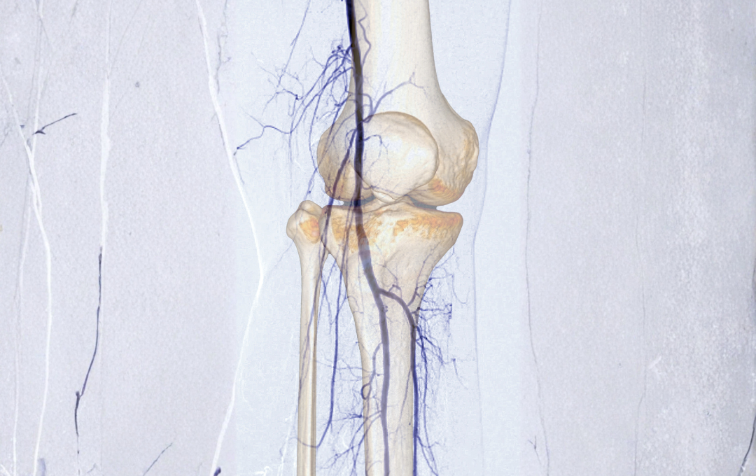 Angiogram of a knee affected by osteoarthritis