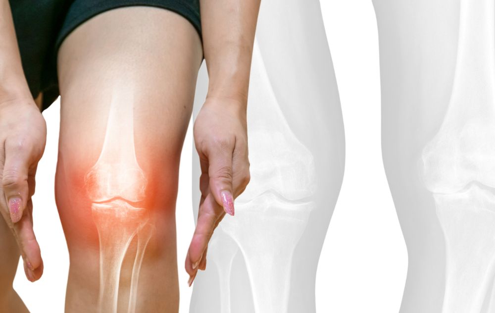 Bone-on-Bone Arthritis Stage