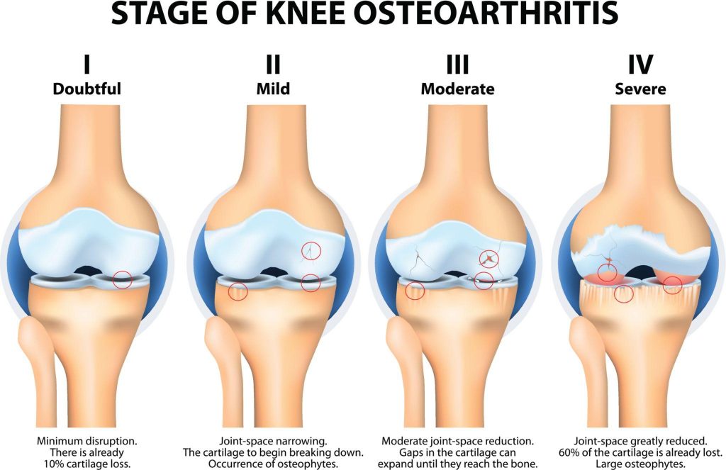 Stages of Knee Arthritis