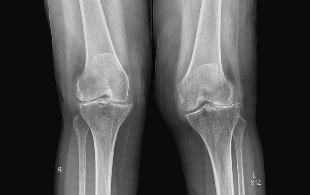 Knee osteoarthritis deteriorates the cartilage