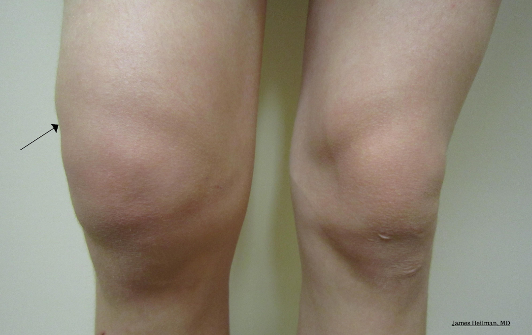 Swelling in the knee. Photograph Courtesy: James Heilman, M.D.